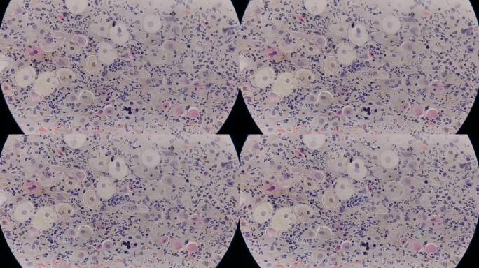 巴氏涂片显微照片:阴道念珠菌感染的炎性涂片。医学概念。