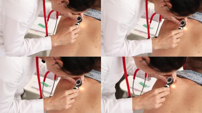 皮肤科医生用放大镜检查病人背部的痣