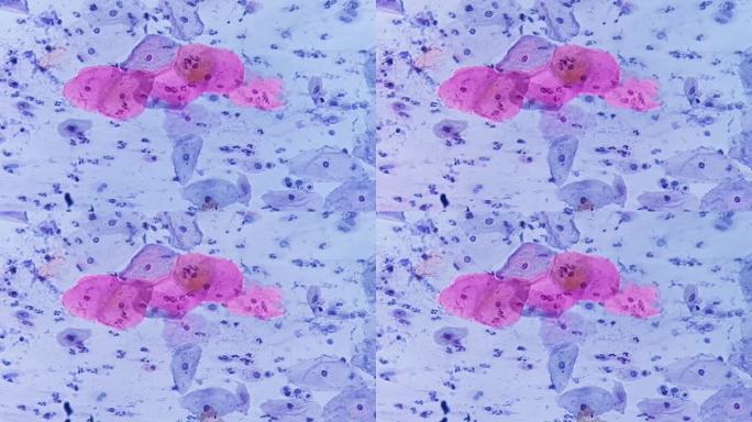 巴氏涂片显微照片:伴有HPV相关改变的炎性涂片。子宫颈癌。鳞状细胞癌