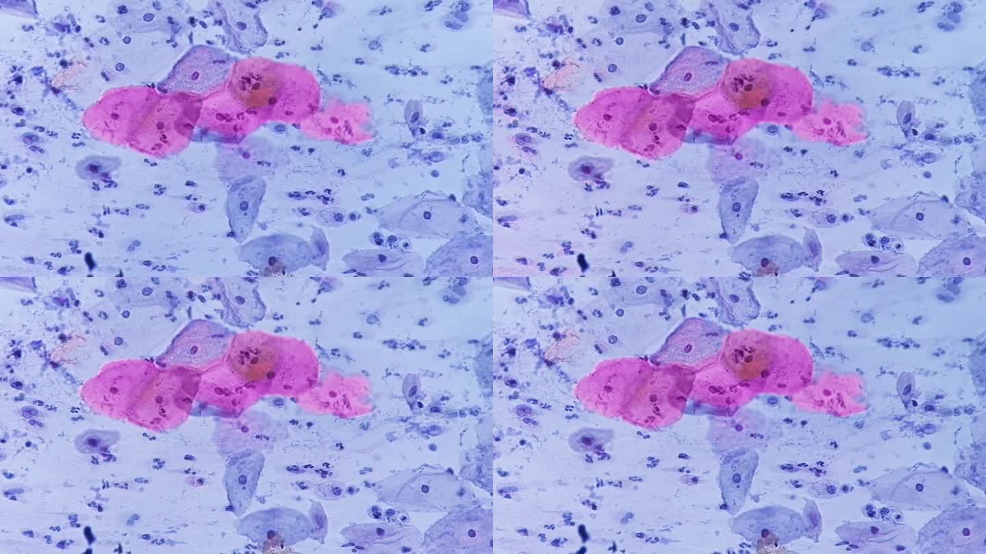 巴氏涂片显微照片:伴有HPV相关改变的炎性涂片。子宫颈癌。鳞状细胞癌
