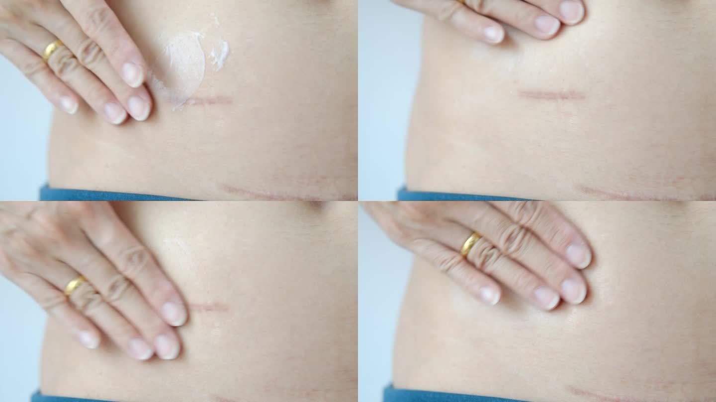 用面霜护理阑尾手术后的疤痕和产后手术伤口