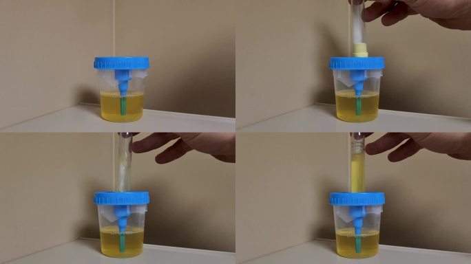 用于尿液分析的尿液样本填充真空试管。