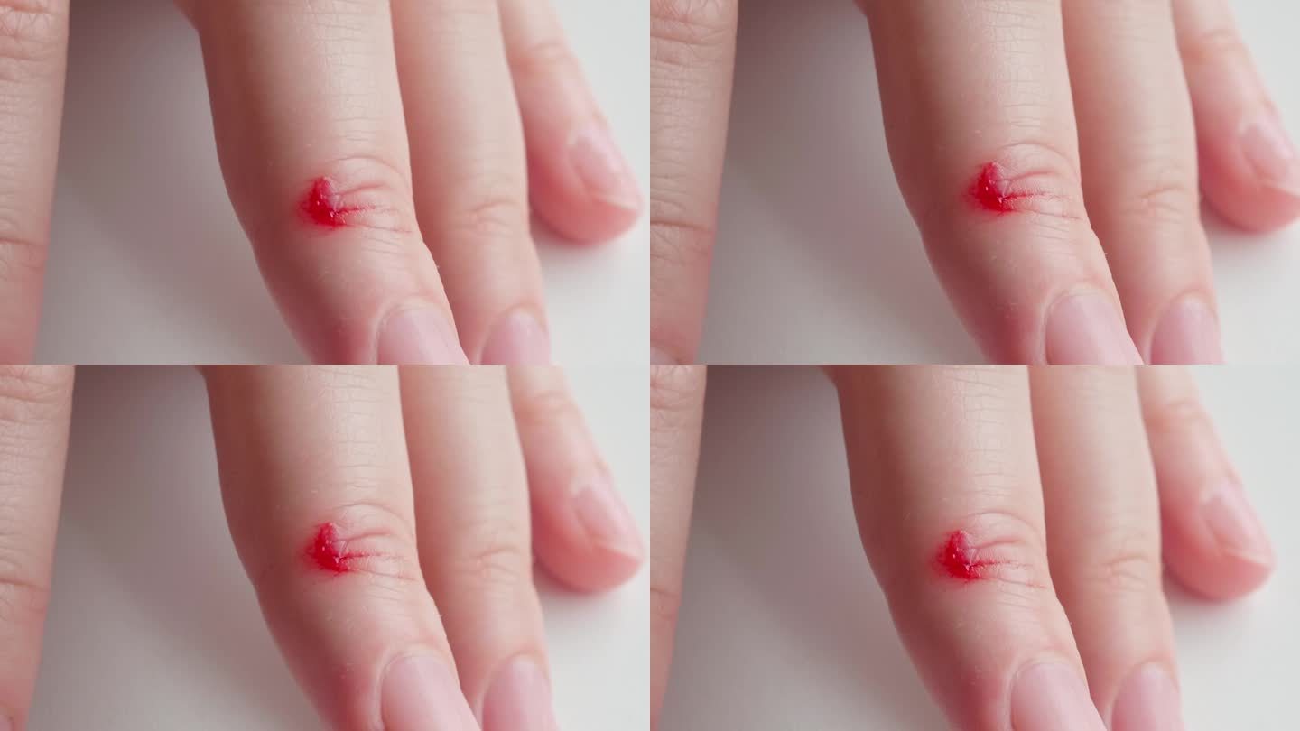 凝胶状的红血块在一个女人中指的伤口上。