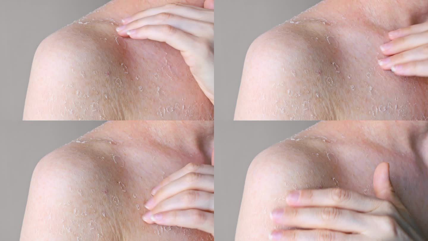 问题皮肤特写皮肤白皙受皮炎影响出现皮肤问题，皮肤病学及美容学肩部皮肤脱皮特写正面观健康问题概念