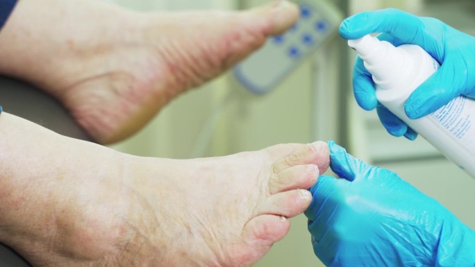 骨科医生用杀菌剂治疗脚的表面。
