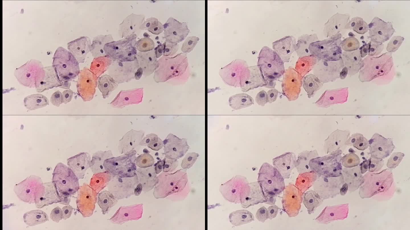 巴氏涂片显微照片:伴有HPV相关改变的炎性涂片。子宫颈癌。鳞状细胞癌