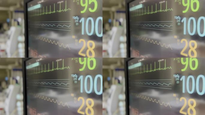 机械通风在儿科重症监护病房4K库存视频的图形