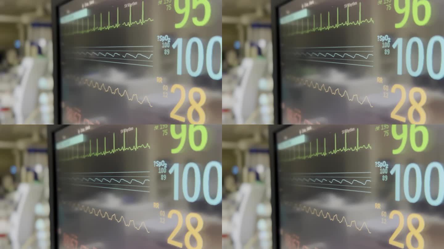 机械通风在儿科重症监护病房4K库存视频的图形