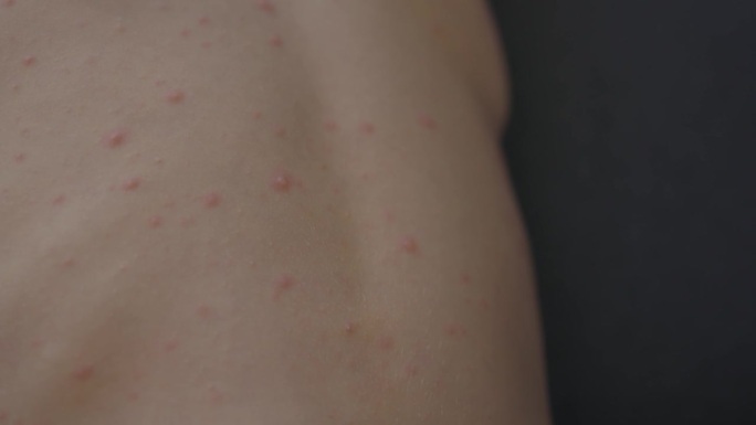 病毒性疾病儿童疾病儿童身上的水痘丘疹症状