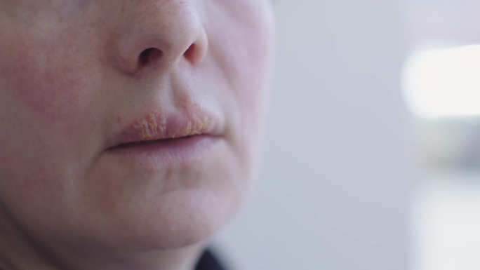 女性嘴唇上的特写疱疹。无法辨认的女人患了大疱疹