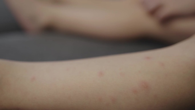 病毒性疾病儿童疾病儿童身上的水痘丘疹症状
