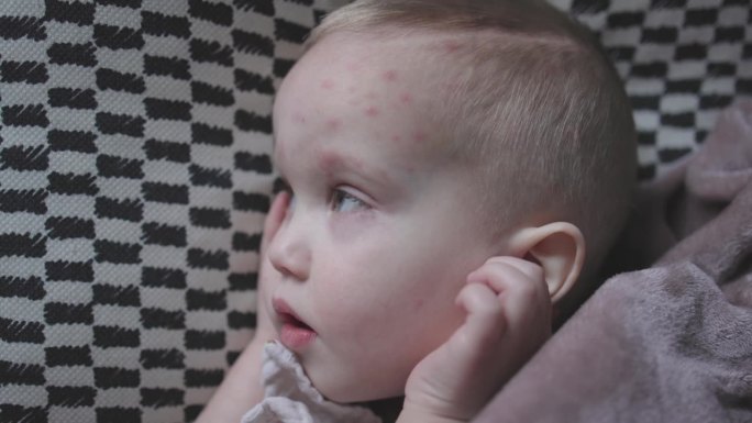婴儿学步的孩子患水痘躺在床上盖毯子的特写