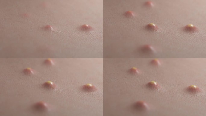 由于毛孔堵塞，粉刺会从皮肤上冒出来