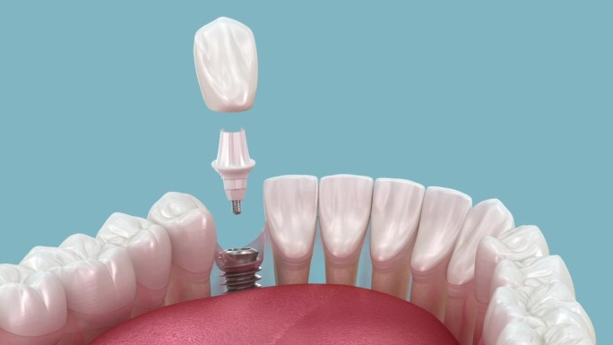 牙种植体安装及牙冠放置。三维动画