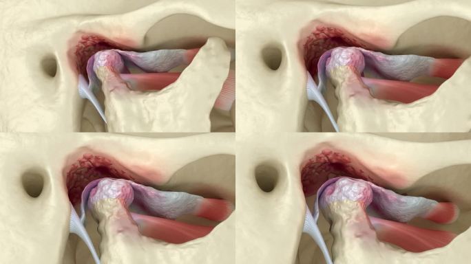 颞下颌关节关节炎和关节盘脱位。牙科3D动画