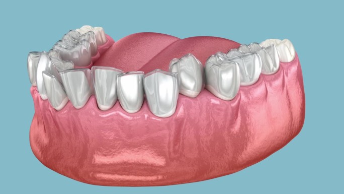 使用隐形牙套或隐形固位器进行咬合矫正。医学上精确的3D动画
