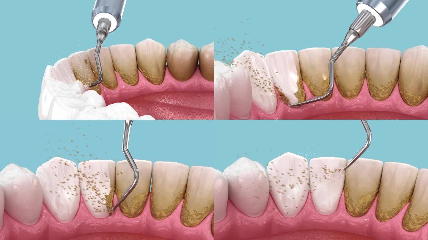 牙齿清洁超声洗牙。医学上精确的人类牙齿治疗3D动画