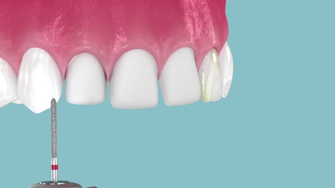牙齿贴面放置在牙齿和快乐的微笑结束。三维动画