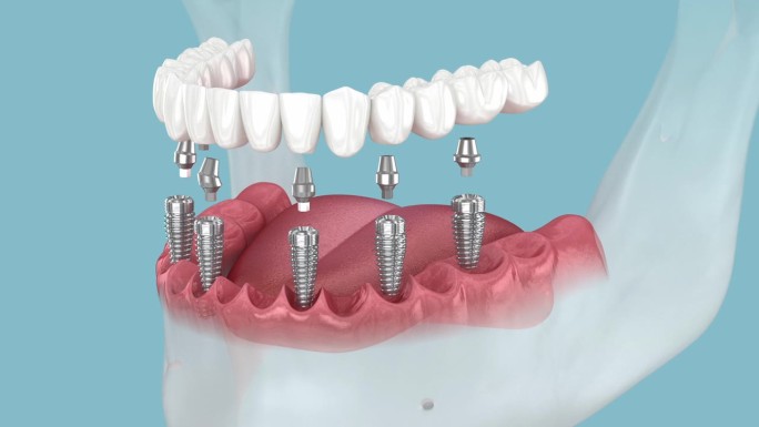 下颌假体固定超过六个种植体。医学上精确的3D动画