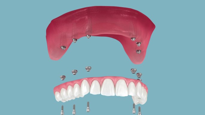 牙齿修复基于六个种植体，最后快乐的微笑。牙科3D动画