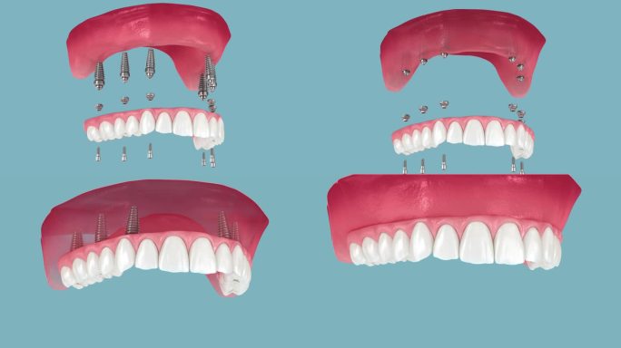 牙齿修复基于六个种植体，最后快乐的微笑。牙科3D动画