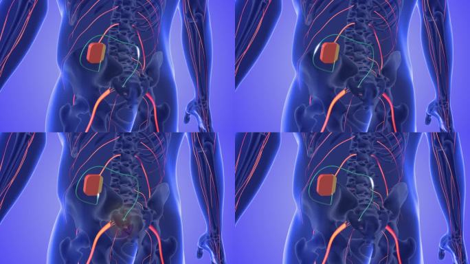 骶神经刺激医学概念