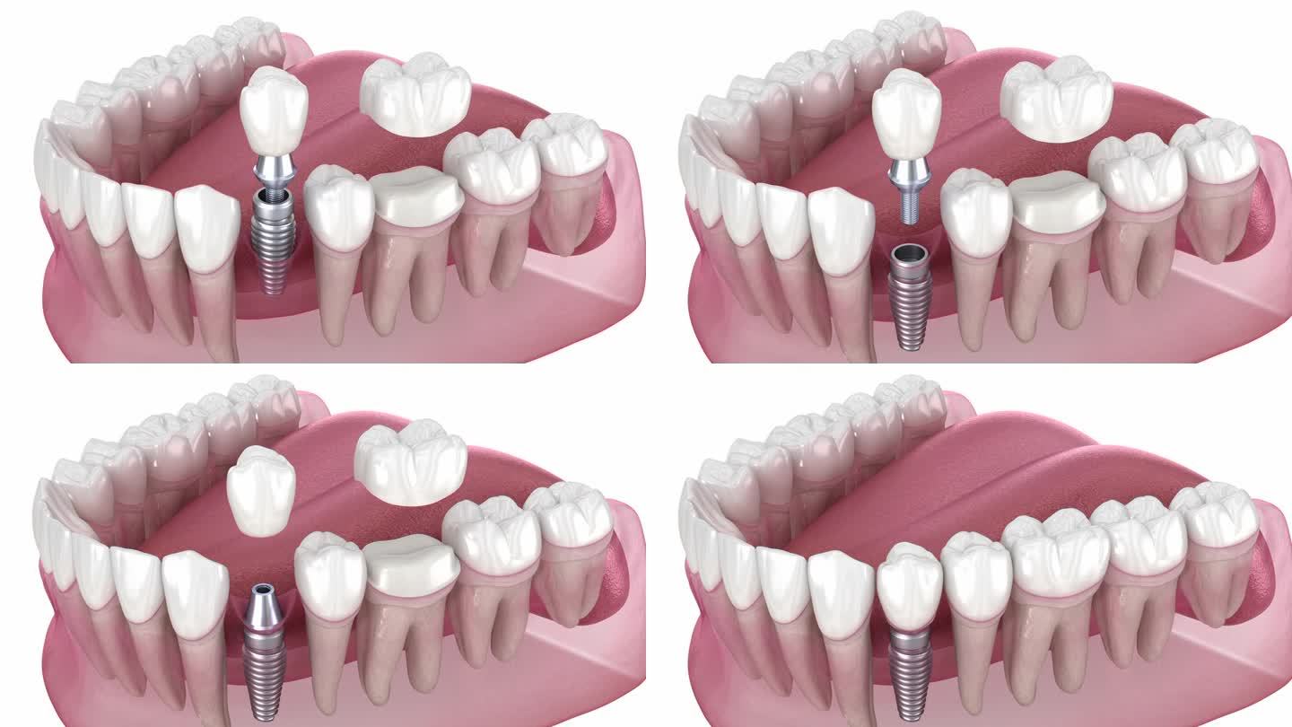 种植牙和牙冠安置。牙科3D动画
