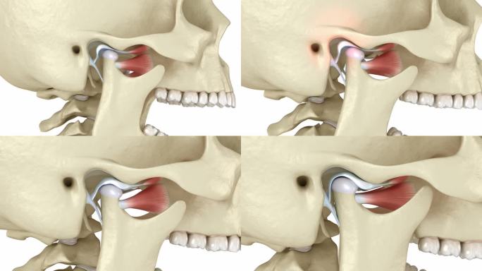 颞下颌关节和关节盘脱位。医学上精确的3D动画