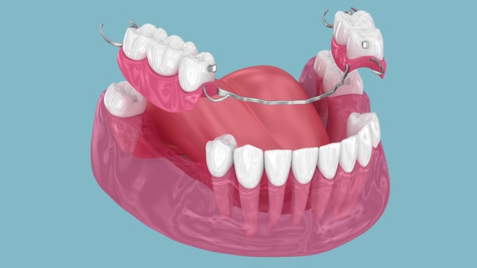 可移动部分义齿，下颌假体。医学上精确的3D动画修复学概念
