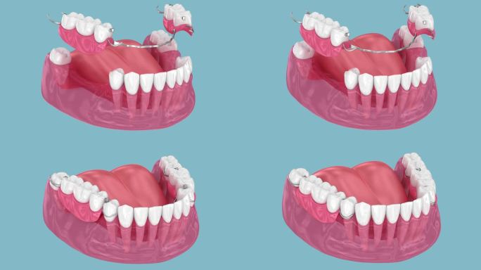 可移动部分义齿，下颌假体。医学上精确的3D动画修复学概念
