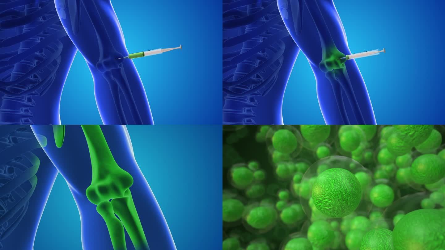 一个动画显示干细胞被注射到人类肘关节