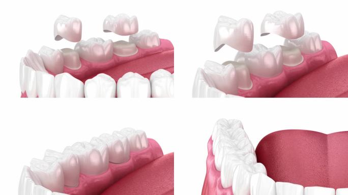 牙冠放置在牙齿上。牙科3D动画
