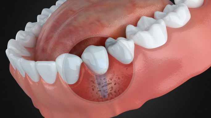 牙齿松动 传统种植牙容易松动