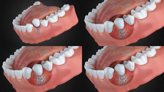 牙齿松动 传统种植牙容易松动