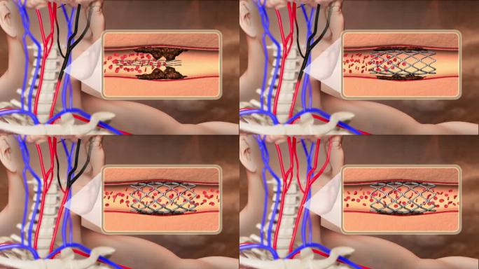 颈动脉堵塞通支架变好