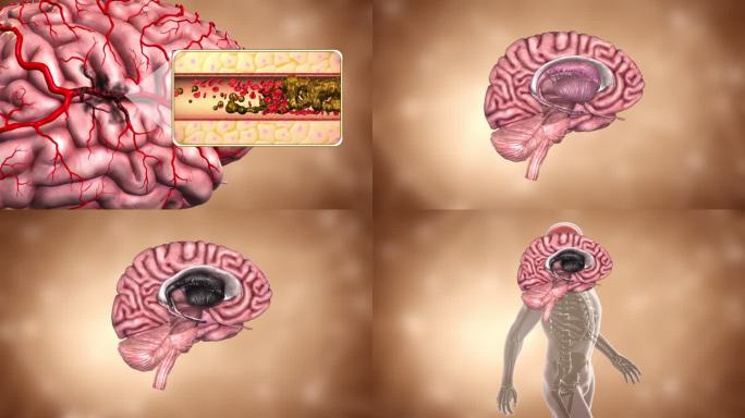 大脑血管堵塞影响信号传导