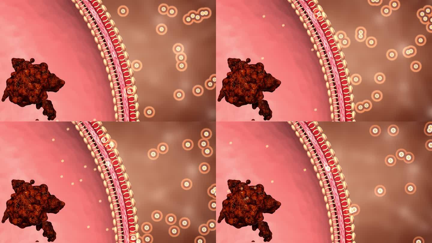 药物小分子穿透血管屏障消除血栓斑块