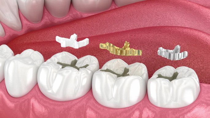 牙科填充物:陶瓷、黄金、金属。牙科3D动画