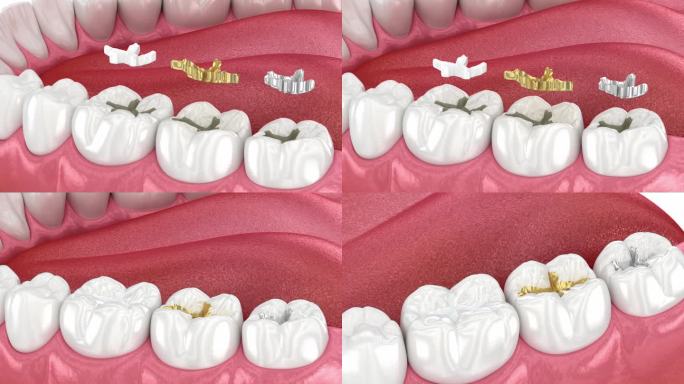 牙科填充物:陶瓷、黄金、金属。牙科3D动画
