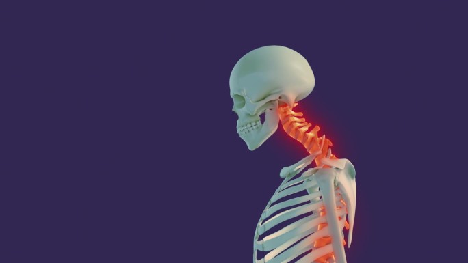 颈椎体位综合征或颈部疼痛的医学动画