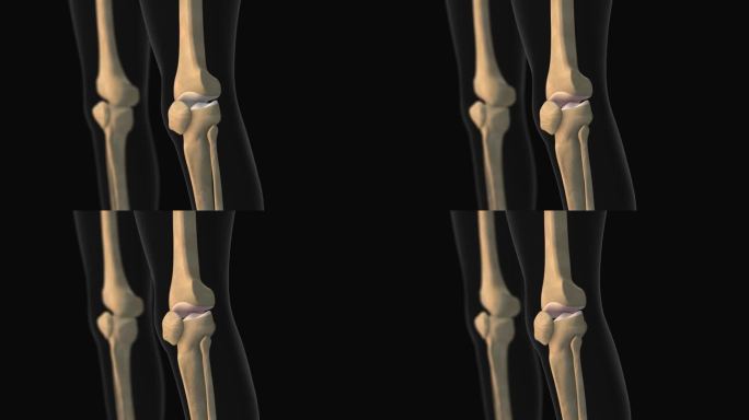 膝关节疼痛的医学动画
