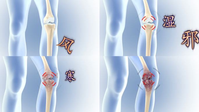 膝盖受风寒湿邪病变骨刺增生