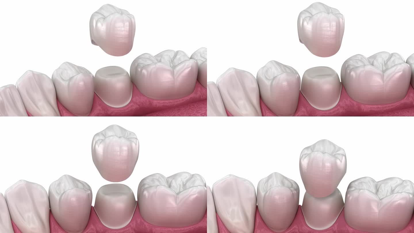 牙冠放置在牙齿上。牙科3D动画
