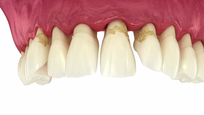 牙周炎和牙龈萎缩，牙齿脱落。牙科3D动画
