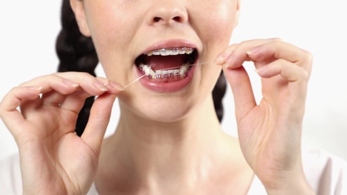年轻的白人妇女用牙托用正畸牙线清洁牙缝。正畸治疗中牙齿护理的概念