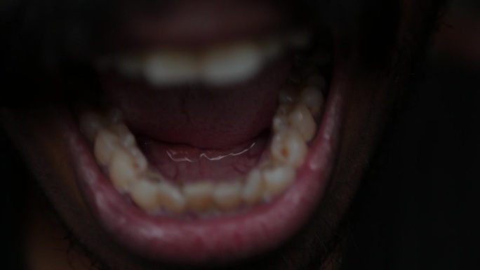 牙龈萎缩，牙齿内侧，牙齿染色
