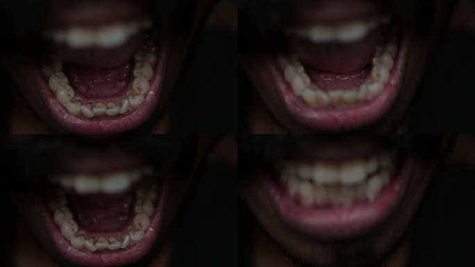牙龈萎缩，牙齿内侧，牙齿染色