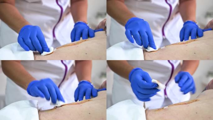 医院手术后，护士的手清洁和治疗腹部损伤的特写。腹部的手术伤口。高品质4k画面