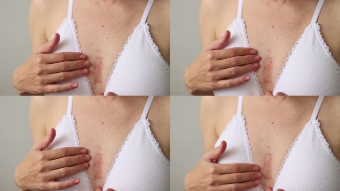 一个胸部有红色湿疹的女人。