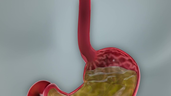 胃酸反流病GERD 3D动画